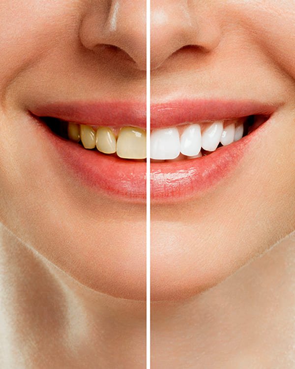 Whitening